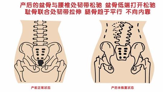 盆底肌修復(fù)